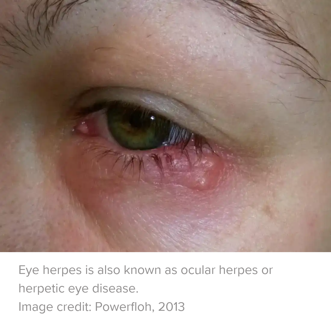 Syphilis and the eyes